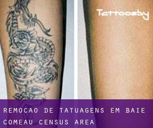 Remoção de tatuagens em Baie-Comeau (census area)