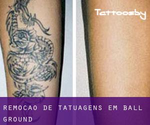Remoção de tatuagens em Ball Ground