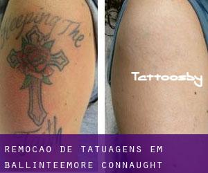 Remoção de tatuagens em Ballinteemore (Connaught)