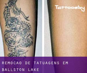 Remoção de tatuagens em Ballston Lake