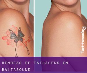 Remoção de tatuagens em Baltasound