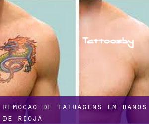 Remoção de tatuagens em Baños de Rioja