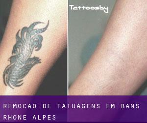 Remoção de tatuagens em Bans (Rhône-Alpes)