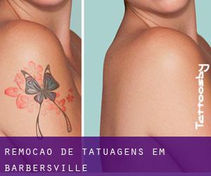 Remoção de tatuagens em Barbersville