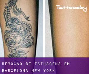 Remoção de tatuagens em Barcelona (New York)
