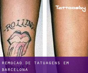 Remoção de tatuagens em Barcelona