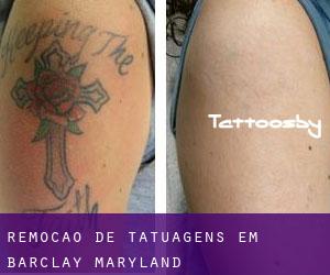 Remoção de tatuagens em Barclay (Maryland)