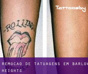 Remoção de tatuagens em Barlow Heights
