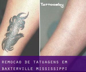 Remoção de tatuagens em Baxterville (Mississippi)