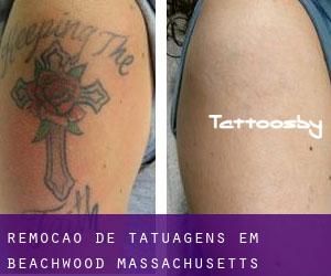 Remoção de tatuagens em Beachwood (Massachusetts)
