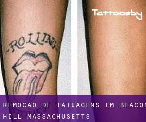 Remoção de tatuagens em Beacon Hill (Massachusetts)