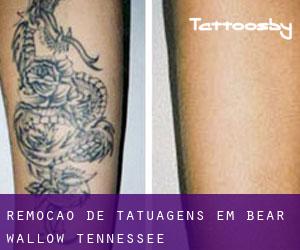 Remoção de tatuagens em Bear Wallow (Tennessee)