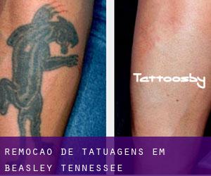 Remoção de tatuagens em Beasley (Tennessee)