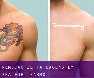 Remoção de tatuagens em Beaufort Farms