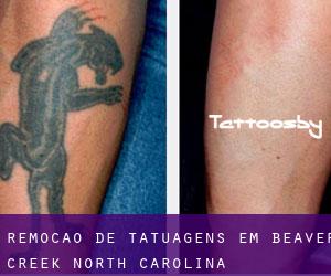 Remoção de tatuagens em Beaver Creek (North Carolina)