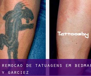 Remoção de tatuagens em Bedmar y Garcíez