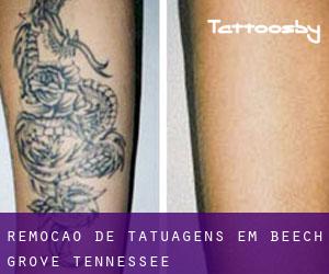 Remoção de tatuagens em Beech Grove (Tennessee)