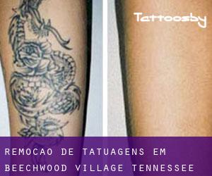 Remoção de tatuagens em Beechwood Village (Tennessee)