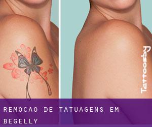 Remoção de tatuagens em Begelly