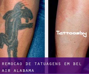 Remoção de tatuagens em Bel Air (Alabama)