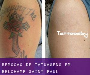 Remoção de tatuagens em Belchamp Saint Paul
