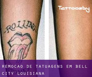 Remoção de tatuagens em Bell City (Louisiana)