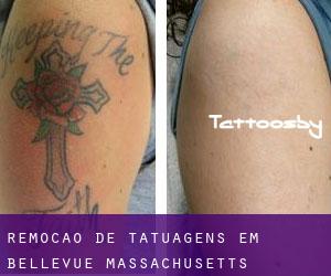 Remoção de tatuagens em Bellevue (Massachusetts)