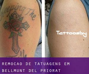 Remoção de tatuagens em Bellmunt del Priorat