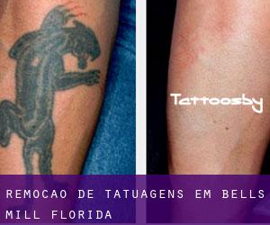 Remoção de tatuagens em Bells Mill (Florida)