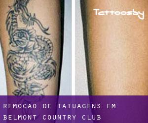 Remoção de tatuagens em Belmont Country Club