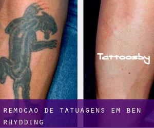Remoção de tatuagens em Ben Rhydding