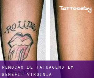 Remoção de tatuagens em Benefit (Virginia)