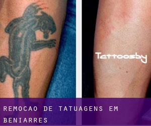 Remoção de tatuagens em Beniarrés