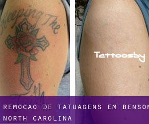 Remoção de tatuagens em Benson (North Carolina)