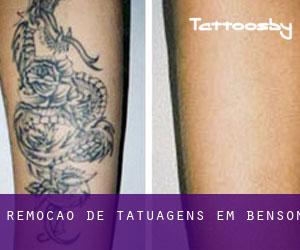 Remoção de tatuagens em Benson