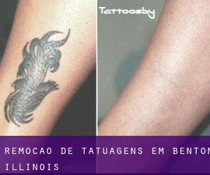 Remoção de tatuagens em Benton (Illinois)