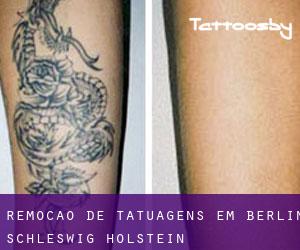 Remoção de tatuagens em Berlin (Schleswig-Holstein)