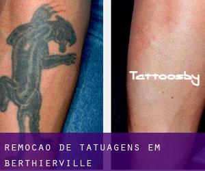Remoção de tatuagens em Berthierville