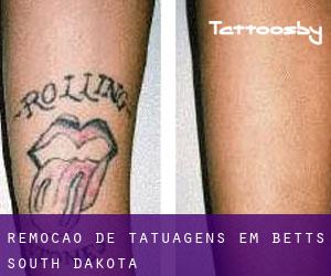 Remoção de tatuagens em Betts (South Dakota)
