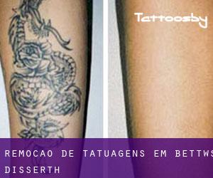 Remoção de tatuagens em Bettws Disserth