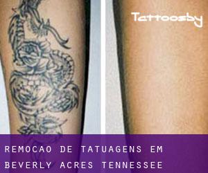 Remoção de tatuagens em Beverly Acres (Tennessee)
