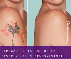 Remoção de tatuagens em Beverly Hills (Pennsylvania)