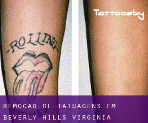 Remoção de tatuagens em Beverly Hills (Virginia)