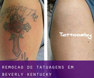 Remoção de tatuagens em Beverly (Kentucky)