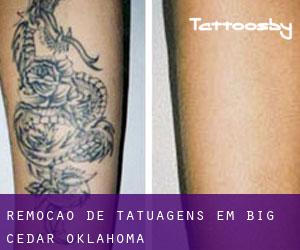 Remoção de tatuagens em Big Cedar (Oklahoma)
