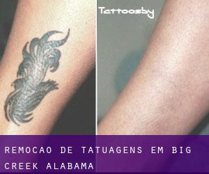 Remoção de tatuagens em Big Creek (Alabama)
