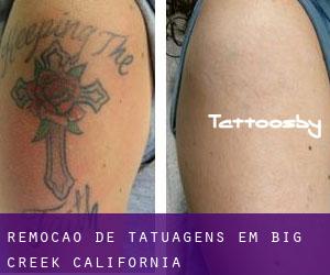 Remoção de tatuagens em Big Creek (California)
