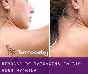 Remoção de tatuagens em Big Horn (Wyoming)