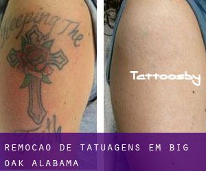 Remoção de tatuagens em Big Oak (Alabama)