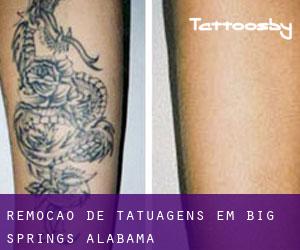 Remoção de tatuagens em Big Springs (Alabama)